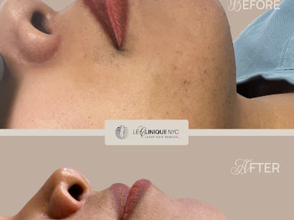 Le Clinique NYC Laser Hair Removal