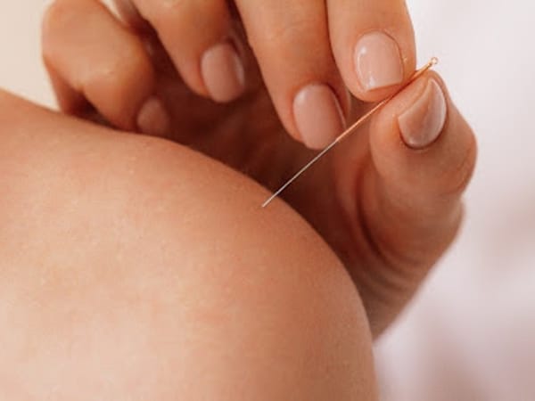 Dry Needling Relief, LLC