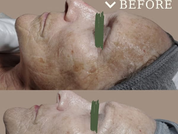 Solano Acne Clinic and Spa