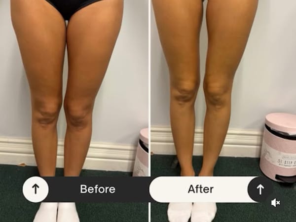 Anaheim body sculpting