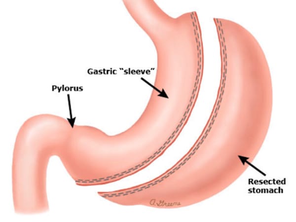 Arch Bariatrics: Kumaran Chinnappan, MD, FACS: Bariatric Weight Loss Surgery