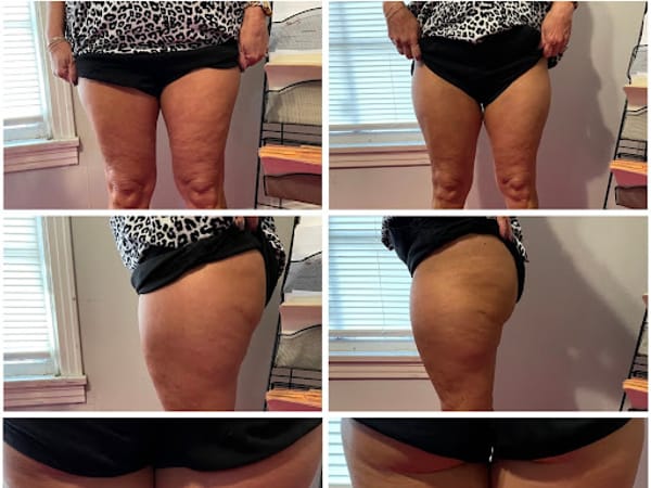 Vanish Body Contouring