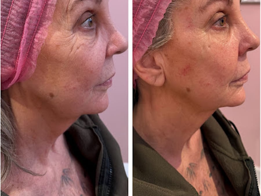 Botox La Belle Peau