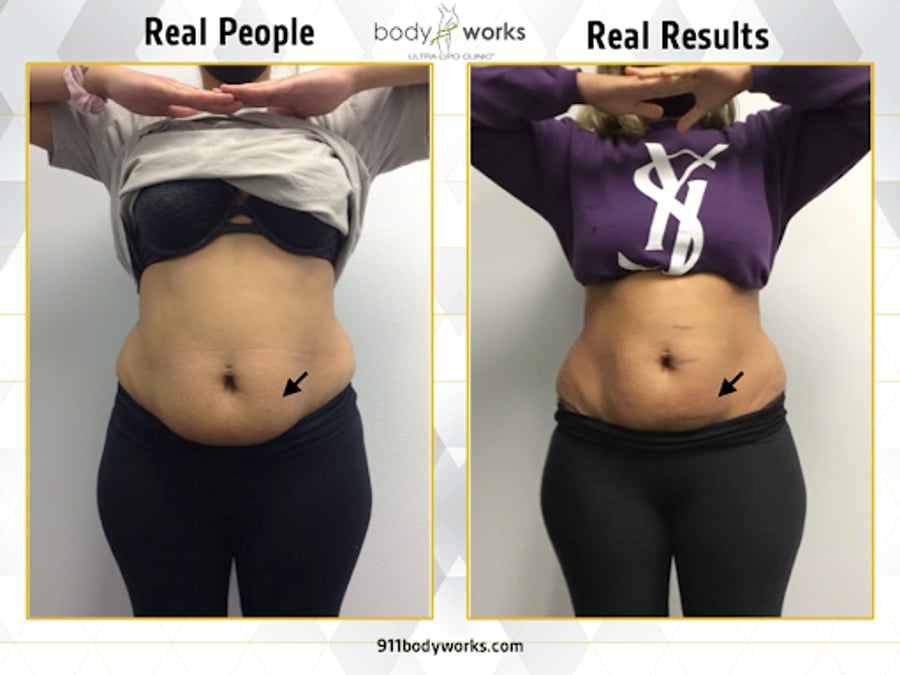 Body Works Ultra Lipo Clinic