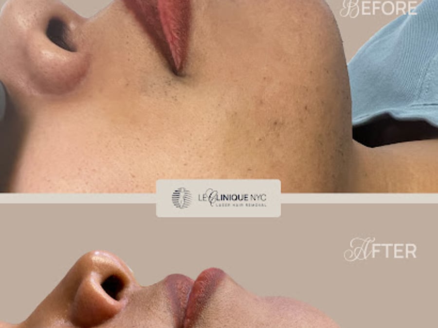 Le Clinique NYC Laser Hair Removal