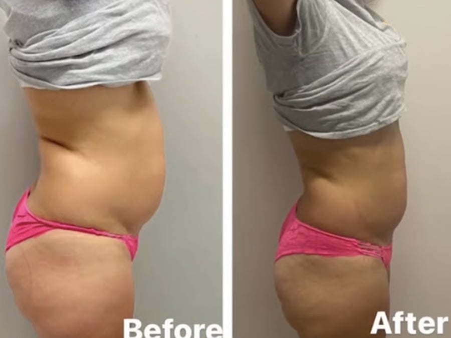Rénu Body Sculpting