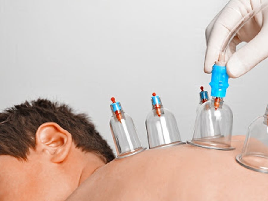 Holistic Hijama Cupping
