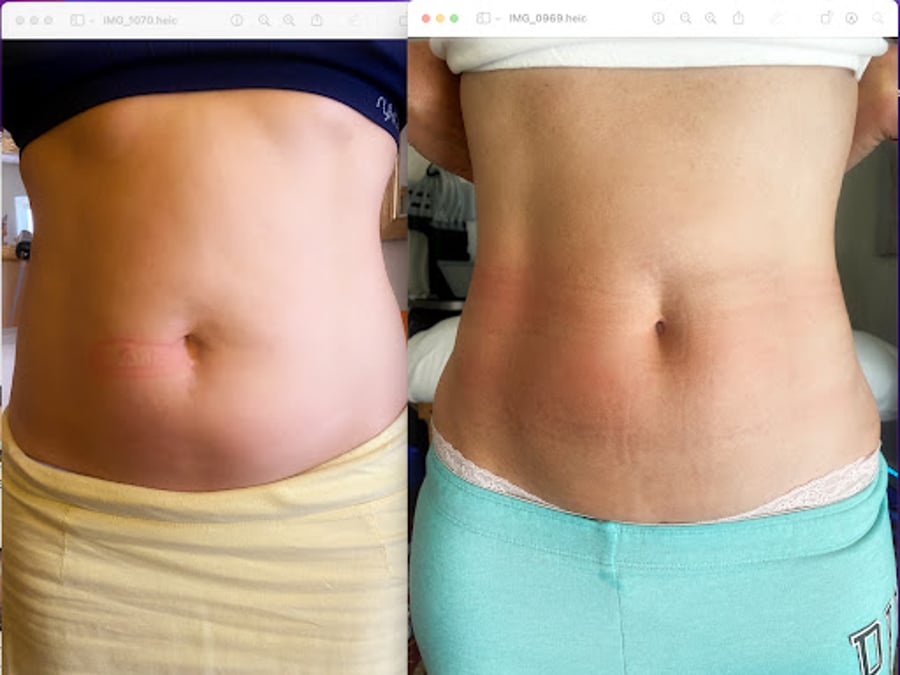 Body Sculpting Santa Barbara