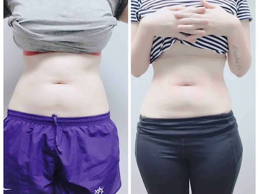California Body Contouring Elite