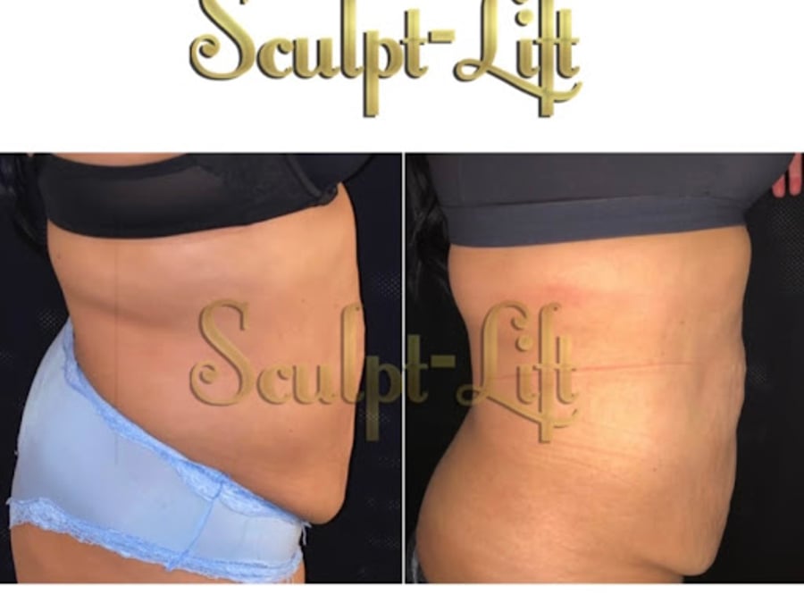 Sculpt-Lift