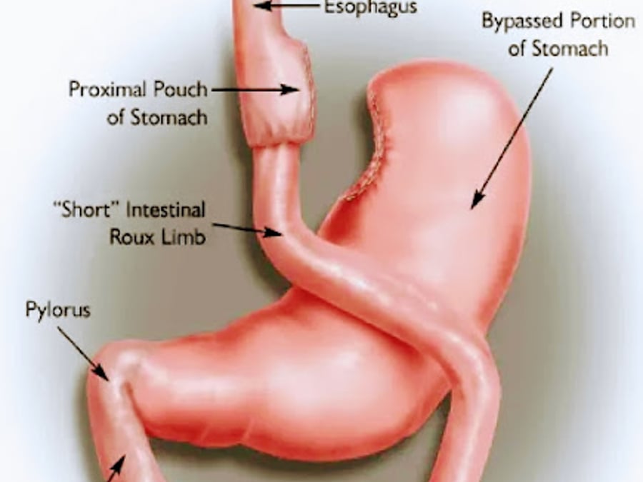 Michigan Bariatric Surgery - Dr. Jason Rizqallah, MD