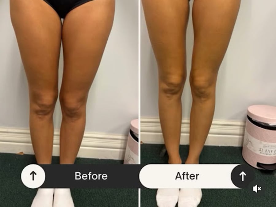 Anaheim body sculpting