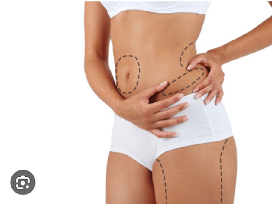 VIP List Laser Lipo & Body Sculpting